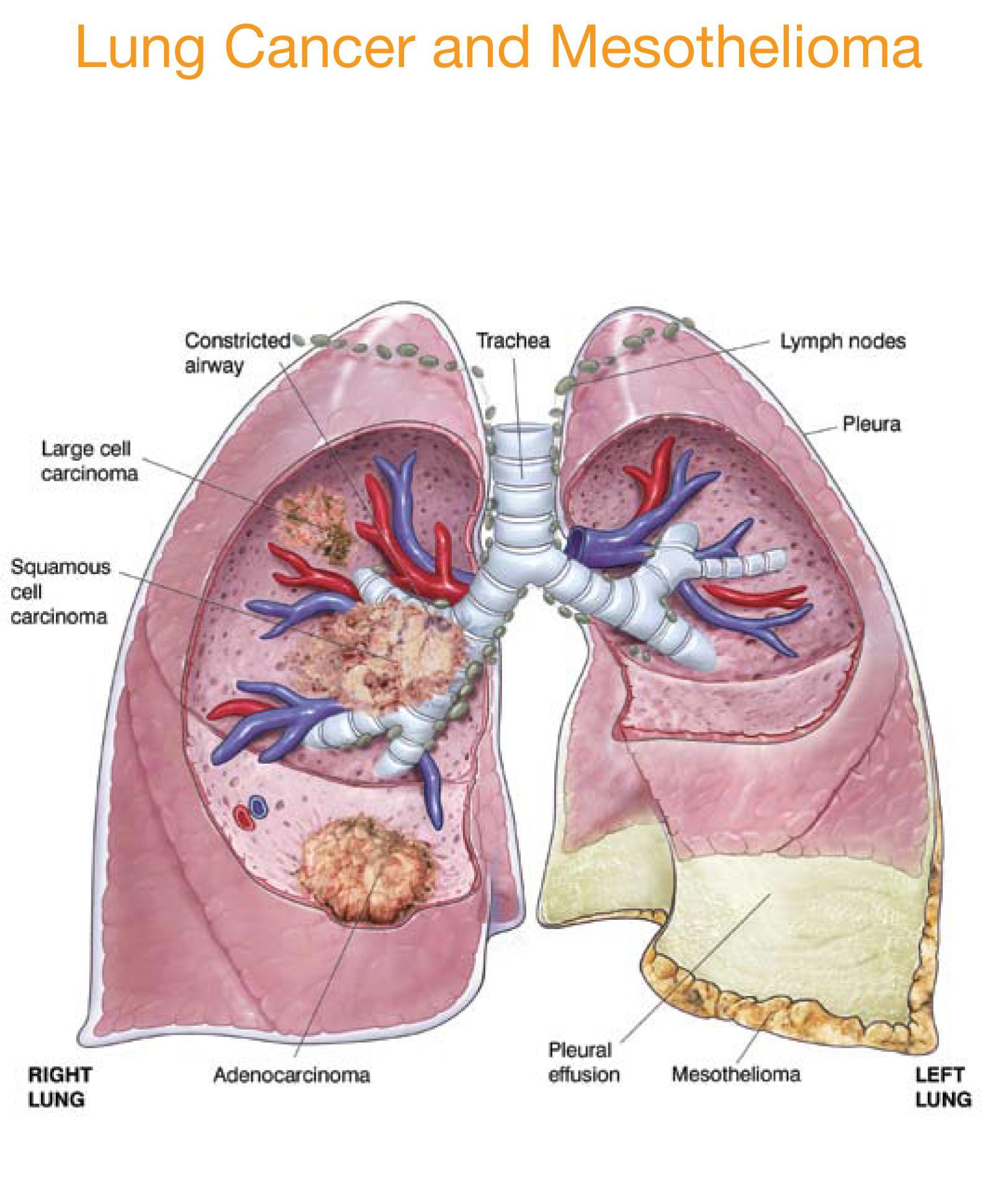 Lung Cancer and Mesothelioma - AMAA